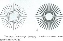 симптоми астигматизму
