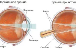 симптоми астигматизму