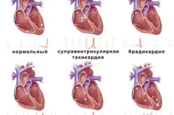 синусовий ритм