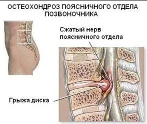 Симптоми поперекового остеохондрозу - ознаки небезпечної хвороби (поперекового відділу хребта) Симптоми поперекового остеохондрозу - ознаки небезпечної хвороби