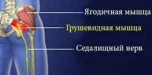 Синдром грушоподібної м'язи що це, прояви та лікування (лікування) Синдром грушоподібної м'язи що це, прояви та лікування