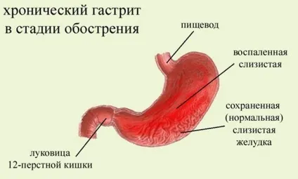 Симптоми хронічного гастриту