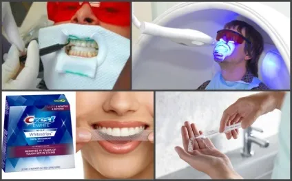 Системи експрес відбілювання зубів white smile, brillante smile та інші