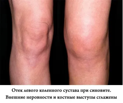 Синовит суть хвороби, причини, симптоми, діагностика та лікування (хвороби) Синовит суть хвороби, причини, симптоми, діагностика та лікування