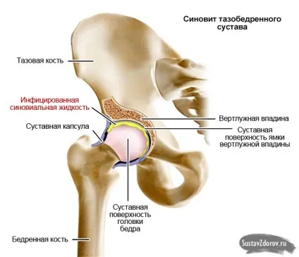 Синовит суть хвороби, причини, симптоми, діагностика та лікування (хвороби) Синовит суть хвороби, причини, симптоми, діагностика та лікування