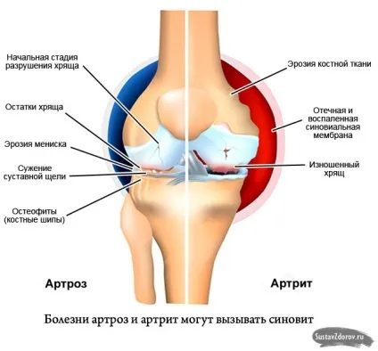 Синовит суть хвороби, причини, симптоми, діагностика та лікування (синовіт) Синовит суть хвороби, причини, симптоми, діагностика та лікування