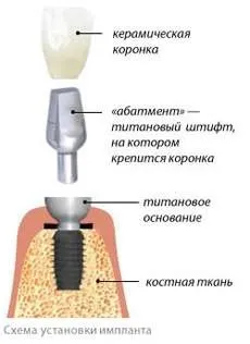Скільки коштує імплантація одного зуба (імплантація одного зуба) Скільки коштує імплантація одного зуба