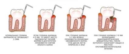 Ступеня пародонтиту види, особливості та способи лікування (пародонтиту) Ступеня пародонтиту види, особливості та способи лікування