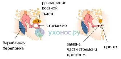 Стапедопластика - операція при отосклерозі вуха (отосклерозі) Стапедопластика - операція при отосклерозі вуха
