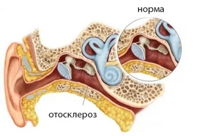 Стапедопластика - операція при отосклерозі вуха (може стати наслідком) Стапедопластика - операція при отосклерозі вуха
