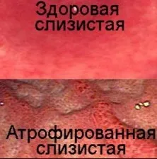 Субатрофіческій гастрит - симптоми, форми, лікування (гастрит) Субатрофіческій гастрит - симптоми, форми, лікування