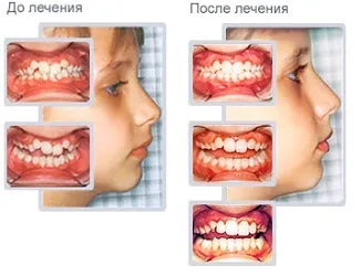 Трейнери для зубів - дитячі і дорослі, відгуки, ціни, фото (зубів) Трейнери для зубів - дитячі і дорослі, відгуки, ціни, фото