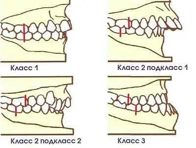 Трейнери для зубів - дитячі і дорослі, відгуки, ціни, фото (зубів) Трейнери для зубів - дитячі і дорослі, відгуки, ціни, фото