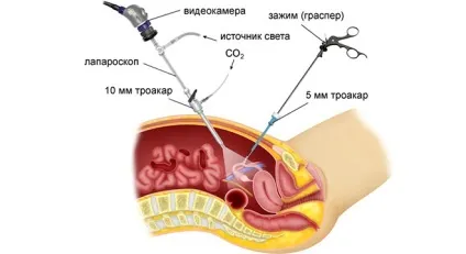 Трубне безпліддя перитональному, лікування