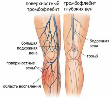 Тромбофлебіт поверхневих вен нижніх кінцівок і його лікування (лікування) Тромбофлебіт поверхневих вен нижніх кінцівок і його лікування