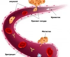 Видалення легкого при раку наслідки, види операцій (види) Видалення легкого при раку наслідки, види операцій