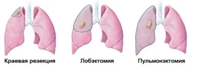 Видалення легкого при раку наслідки, види операцій (легкого) Видалення легкого при раку наслідки, види операцій