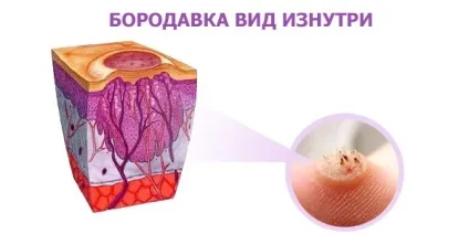 Видалення бородавок лазером подробиці процедури (бородавок) Видалення бородавок лазером подробиці процедури