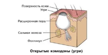 Угри на обличчі лікування в домашніх умовах, проблемна шкіра, прищів у жінок (лікування) Угри на обличчі лікування в домашніх умовах, проблемна шкіра, прищів у жінок