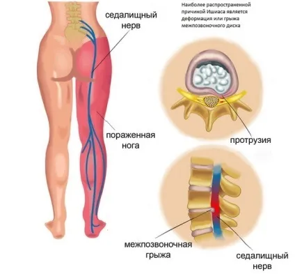 Укол в сідничний нерв наслідки, що робити при пошкодженні (наслідки) Укол в сідничний нерв наслідки, що робити при пошкодженні