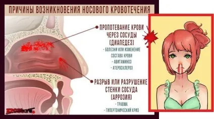 У дитини пішла кров - лікування кровотеч (носовий) У дитини пішла кров - лікування кровотеч