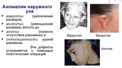 У новонародженого різні вушні раковини чому різна форма вух (вушні) У новонародженого різні вушні раковини чому різна форма вух