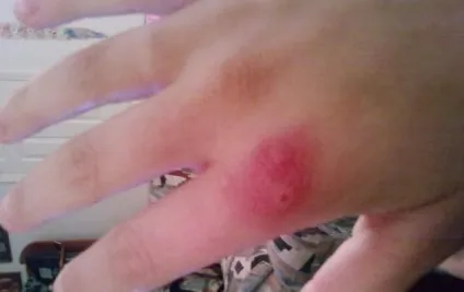 Укус тарантула небезпечно напад павука на людину (людини) Укус тарантула небезпечно напад павука на людину