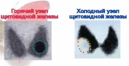 Вузол правої частки щитовидної залози ознаки і лікування (частки щитовидної залози) Вузол правої частки щитовидної залози ознаки і лікування