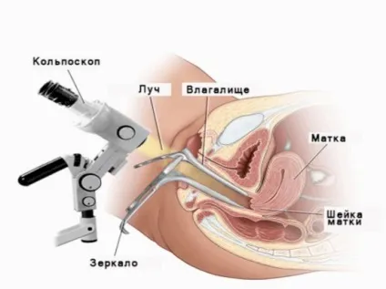 Узі шийки матки при вагітності