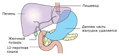 Види операцій при раку шлунка