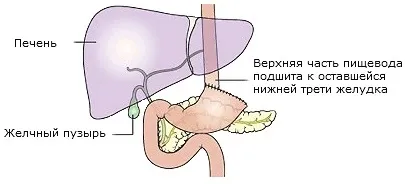 Види операцій при раку шлунка