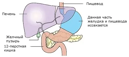 Види операцій при раку шлунка