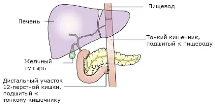 Види операцій при раку шлунка