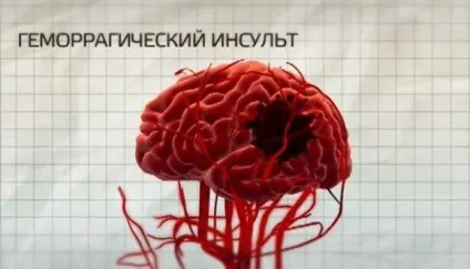 Види інсульту головного мозку і їх відмінності (види) Види інсульту головного мозку і їх відмінності