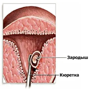 види абортів