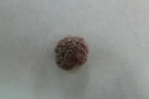 Внутрідермальний невус фото, derm-info (невус) Внутрідермальний невус фото, derm-info
