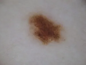 Внутрідермальний невус фото, derm-info (невус може трансформуватися) Внутрідермальний невус фото, derm-info