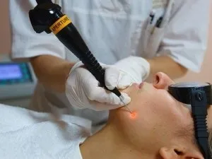 Внутрідермальний невус фото, derm-info (невус) Внутрідермальний невус фото, derm-info