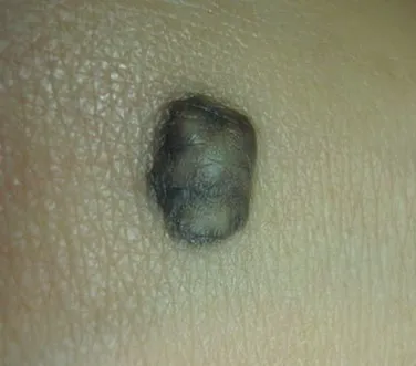 Внутрідермальний невус фото, derm-info (невус може трансформуватися) Внутрідермальний невус фото, derm-info