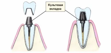 Вкладка на зуб під коронку що таке, види і установка (коронку) Вкладка на зуб під коронку що таке, види і установка