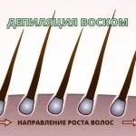 Віск або шугарінг що краще