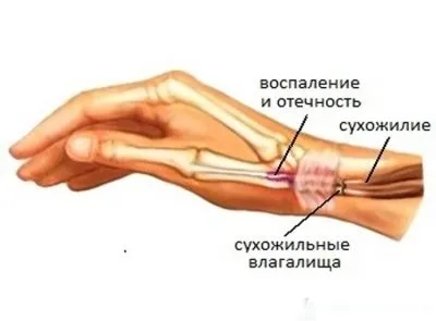 Запалення сухожиль кисті руки причини і лікування (сухожиль) Запалення сухожиль кисті руки причини і лікування