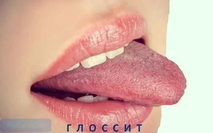 Запалення мови як виникає і чим лікують глосит (глосит) Запалення мови як виникає і чим лікують глосит