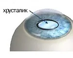 Кришталик - будова, функції, захворювання кришталика (будова) Кришталик - будова, функції, захворювання кришталика