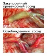 Холестеринові бляшки в сонної артерії як прибрати і чи можуть розчинитися самі (сонної) Холестеринові бляшки в сонної артерії як прибрати і чи можуть розчинитися самі