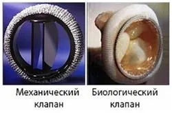 Заміна мітрального клапана серця
