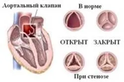 Заміна мітрального клапана серця