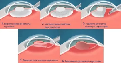 Заміна кришталика ока при катаракті - вартість операції (фото, відео) (заміна) Заміна кришталика ока при катаракті - вартість операції (фото, відео)