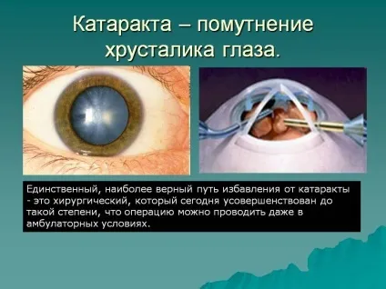 Заміна кришталика ока при катаракті - вартість операції (фото, відео) (кришталика) Заміна кришталика ока при катаракті - вартість операції (фото, відео)