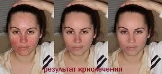 Рідкий азот в косметології для обличчя коли призначають процедуру, протипоказання, фото до і після (процедуру) Рідкий азот в косметології для обличчя коли призначають процедуру, протипоказання, фото до і після